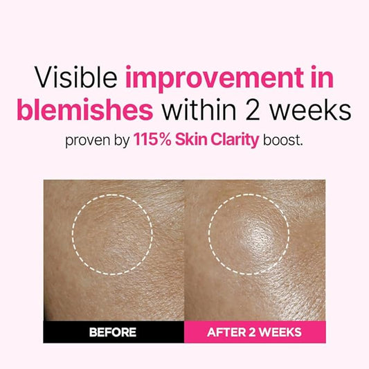 ISOI Blemish Care Up Serum for Face, Vegan Hydrating Serum for Smooth & Glass Skin Effect, Skin Barrier & Moisture Balance for Women, Korean Skin Care (0.85 fl. oz, 25ml)