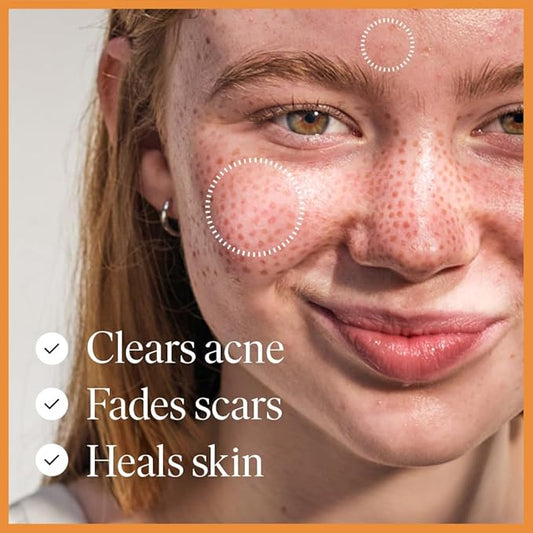 Hydrating Face Serum for Clearing Acne and Scars, Anti-Blemish & Scar Repair Serum Skincare Treatment with Silver Chitoderm Smooth Skin Moisturiser Serum for All Skin Types (1.69 oz)