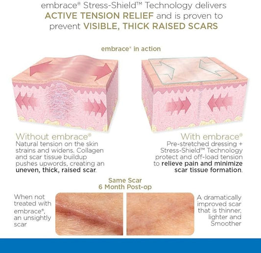 Embrace Active Scar Defense for New Scars, FDA-Cleared Medical-Grade Silicone Scar Sheets for Hypertrophic & Keloid Scar Treatment, 4.7 Inch, Large, 30-Day Supply