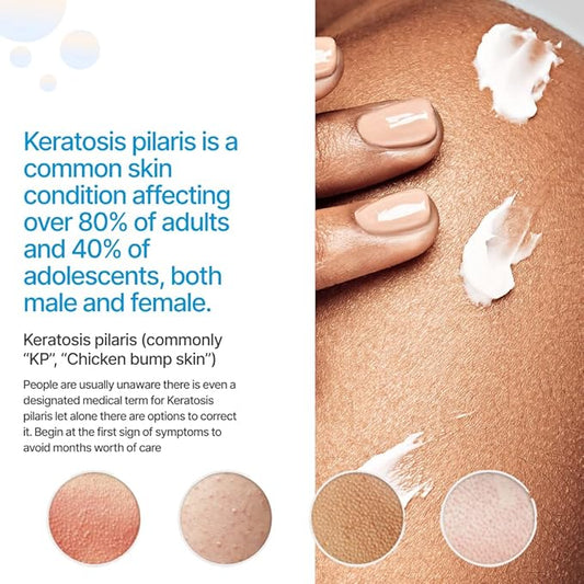 KP Essentials - Keratosis Pilaris Exfoliating Cream - Clear Red Bumps on Thighs and Arms For Confident Clear Skin - 4oz (1 Bottle)