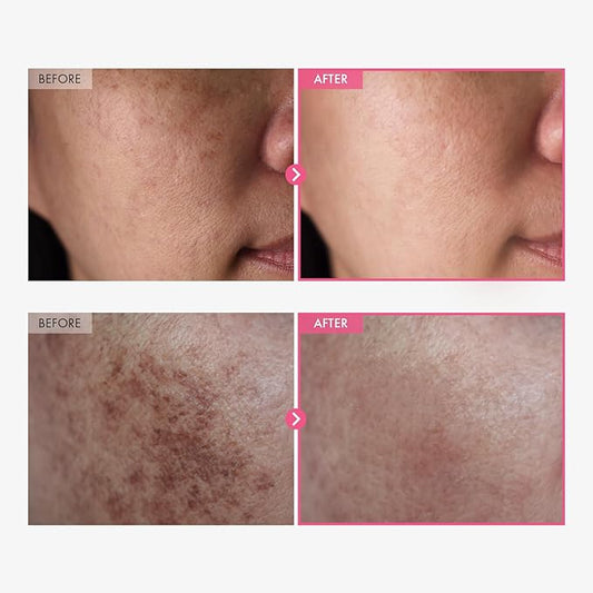 Arbutin 7% + Tranexamic Acid 4% Cream, 70,000ppm Arbutin, 40,000ppm TXA, Niacinamide, Glutathione, Dark Spots, Freckle, Blemishes, Pigmentation, Korean Skin Care, 50ml, 1.69 fl.oz.