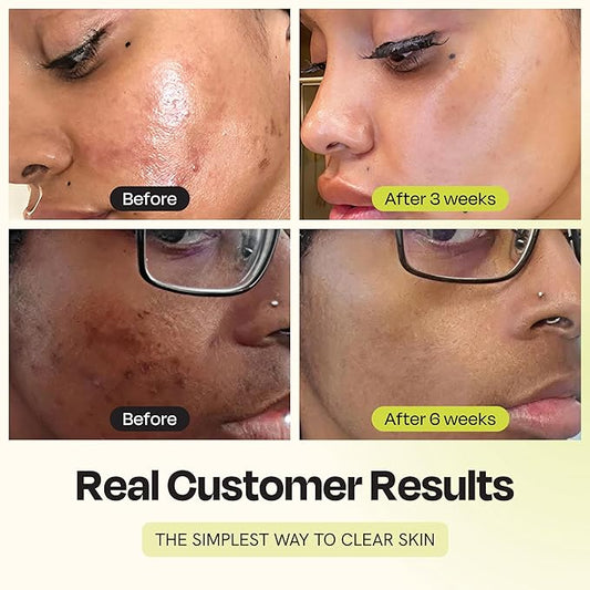 Gleamin Vitamin C Clay Mask for Dark Spots, Turmeric Clay Face Mask Skin Care, Deeply Cleanses & Refines Pores, Brightens Uneven Tone and Helps Improve Post-Blemish Scarring & Texture, Up to 20 Uses