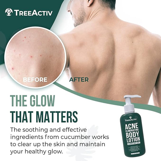 TreeActiv Acne Eliminating Body Lotion 8 fl oz | Clears Body, Back, Butt and Shoulder Acne | Anti-Acne Moisturizer | Prevents Future Breakouts | Cucumber Mint Scent