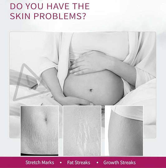 Stretch Mark Removal Cream, Obesity Stretch Mark Moisturizer, Postpartum Repair Stretch Mark Cream, Abdominal Stretch Mark Cream, Remove Marks (2 PCS)