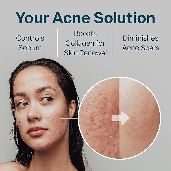 QRxLabs Glycolic/Salicylic Acid 10/2 Acne Control Pads with 10% Ultra Pure Glycolic + 2% Salicylic Acid, Allantoin, Vitamins B5, C & E, Calendula Green Tea - Most Effective Treatment Clear Skin - 2PK