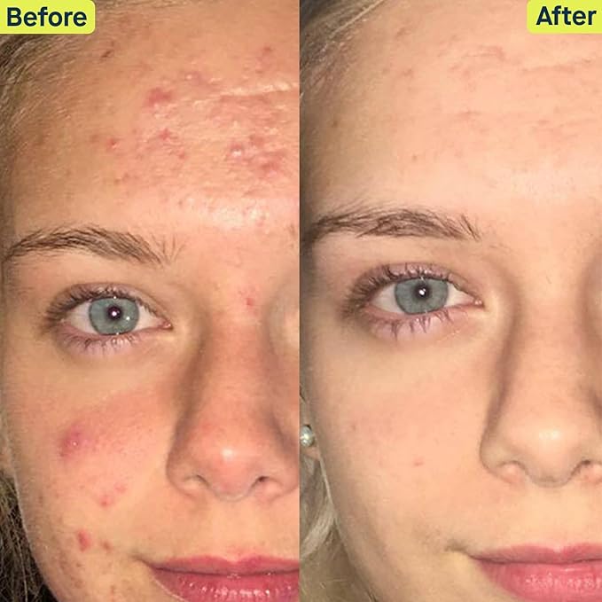 SLMD Skincare by Dr. Pimple Popper - 30-Day Acne System - 4-pc Kit - 3 Steps, 2x per Day Full Routine to Treat and Prevent All Stages of Acne