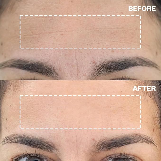 Wrinkles Schminkles Forehead Wrinkle Patches, 4-Pack, Reusable Hypoallergenic Silicone Smoothing Pads for Reducing Frown Lines & Face Lift Overnight