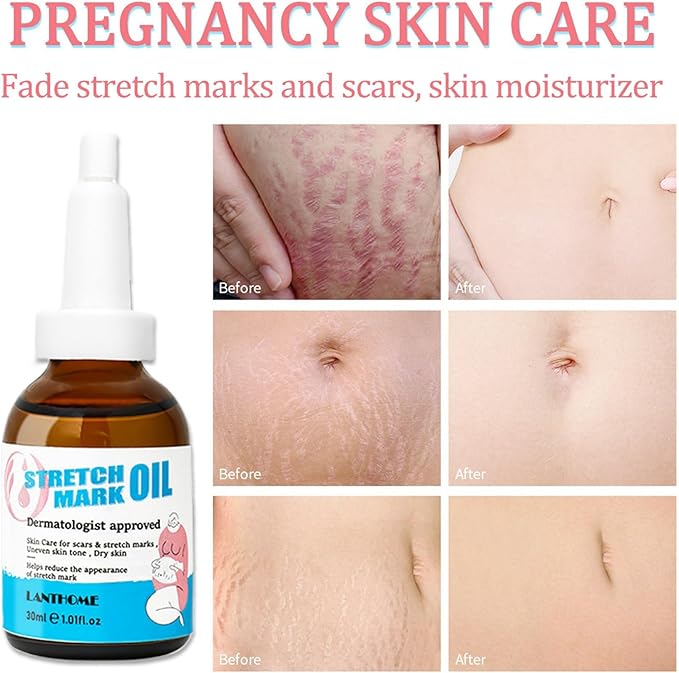 Stretch Mark Pregnancy Massage Oil, Stretch Mark Oil, Skincare Oil for Improve Stretchmarks, Pregnancy Skin Care Fade Stretch Marks, Body Moisturizer for Dry Skin, First Time Mom Gift 30 ml
