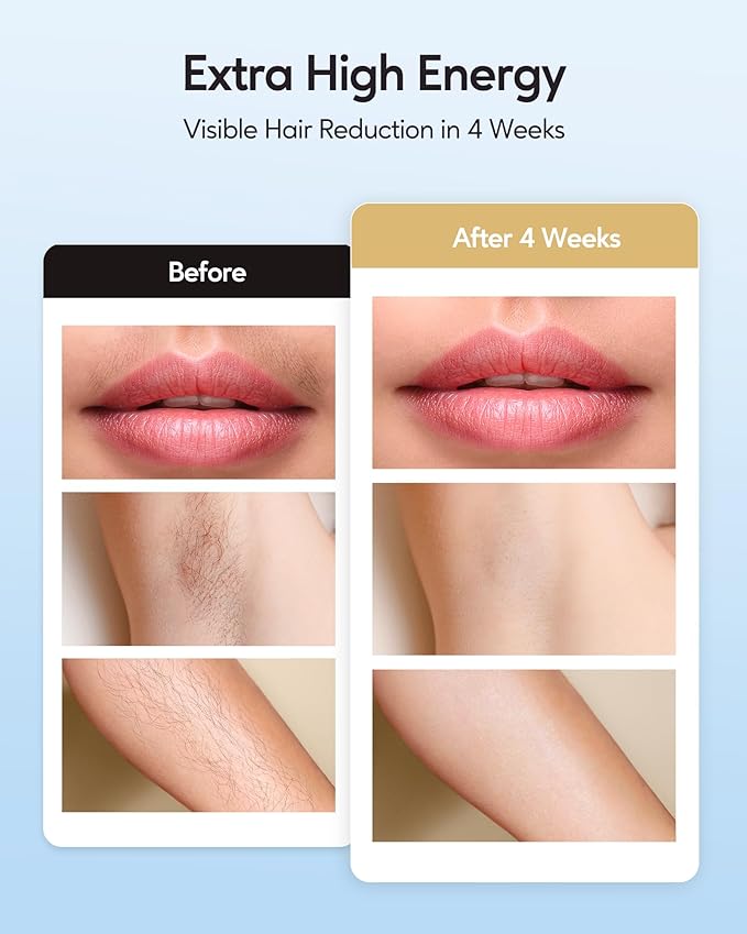 INNZA IPL Hair Removal with Ice Cooling Care Function for Women,Long-Lasting Results,999,999 Flashes Painless IPL Hair Remover, Hair Removal Device for Armpits Legs Arms Bikini Line