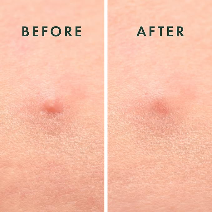 Rael Pimple Patches, Miracle Microcrystal Spot Cover - Hydrocolloid Acne Patch with Tea Tree Oil, Early Stage Zits and Blemish, Korean Skin Care, Vegan, Cruelty Free (36 Count)