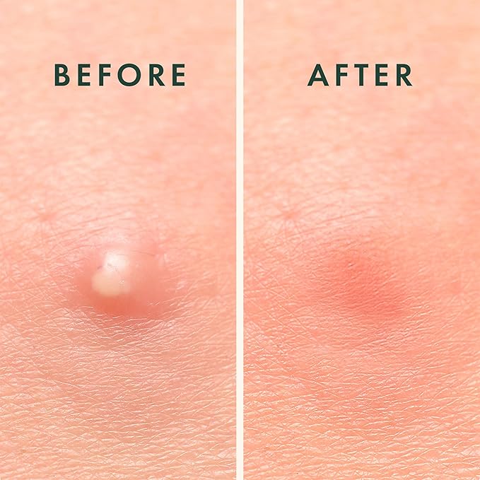 Rael Pimple Patches - Miracle Overnight Spot Cover, Thicker & Extra Adhesion, Hydrocolloid Acne Treatment for Face, Zits & Blemishes, Korean Skin Care, Vegan & Cruelty-Free, 3 Sizes (52 Count)