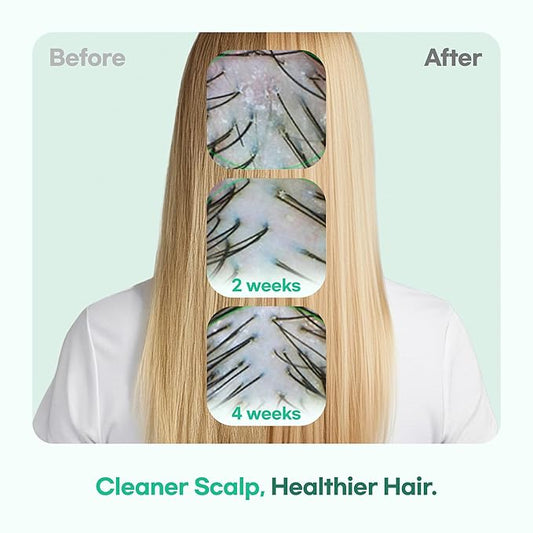 TS GD Shampoo for Teens | Korean Anti-Dandruff Shampoo for Oily & Itchy Scalp | Fruity Allergy-Free Scent | Sulfate-Free Gentle Hair Care (14.1 Oz)